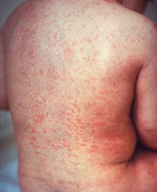 measles outbreak